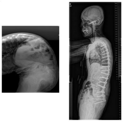 <그림 5>수술전(허리 굽읍증이 심한 상태; 좌측), 수술후(허리 직립이 가능해진 상태; 우측)