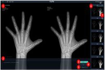 VUNOmed-BoneAge는 환자의 좌측 손 X-ray 영상을 GP 방식을 기반으로 뼈나이 모델을 분석해 의료인이 환자의 뼈나이를 판단하는 것을 지원하는 소프트웨어