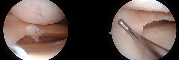 연골판부분절제술 전(왼쪽)과 후(오른쪽)
