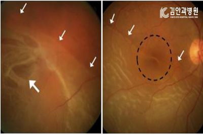 갑작스러운 시력저하로 안과를 방문 후 망막박리를 진단 받은 환자의 망막 신경