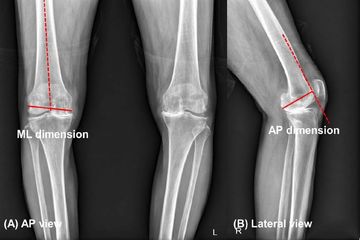무릎 수술전 x-ray에서 대퇴골 모양 파악을 위한 가로 세로 길이 측정