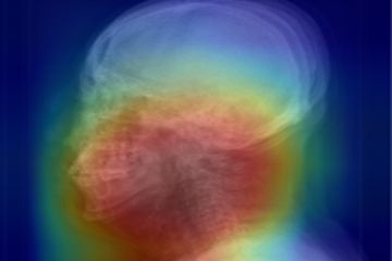 두경부 X-ray 영상을 활용한 수면무호흡증 진단 예시; 딥러닝 알고리즘이 수면무호흡증 여부를 분류하는 이미지 상 특이점의 위치(붉은색)를 확인할 수 있다.